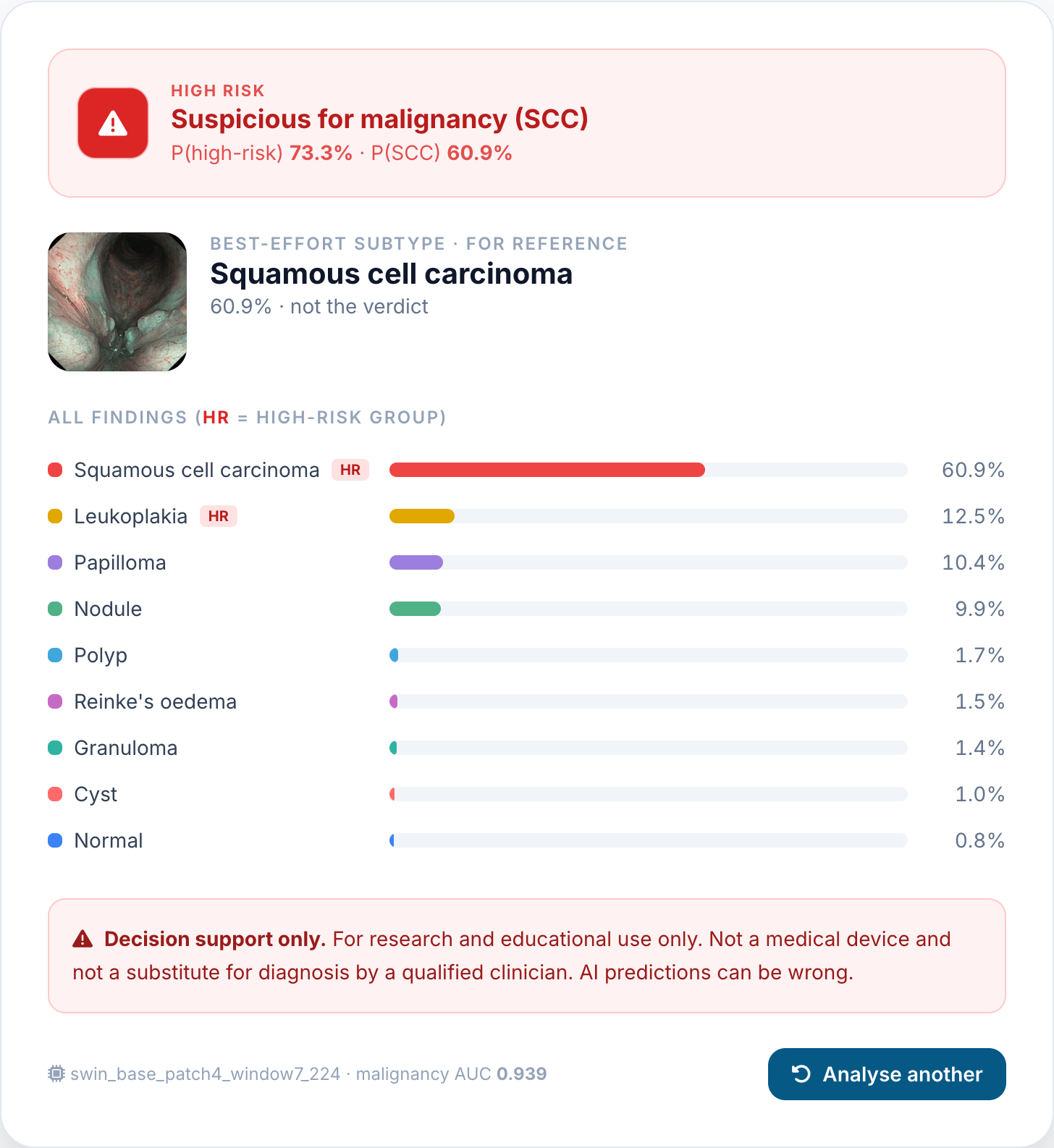 VoxLensAI analysis results showing a high-risk verdict with per-class probabilities